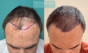 FUE hair transplant for the hairline restoration before after photo