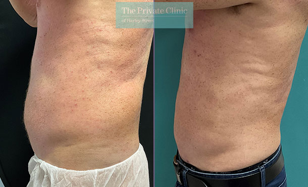 liposuction harley street cosmetic surgery before after photo