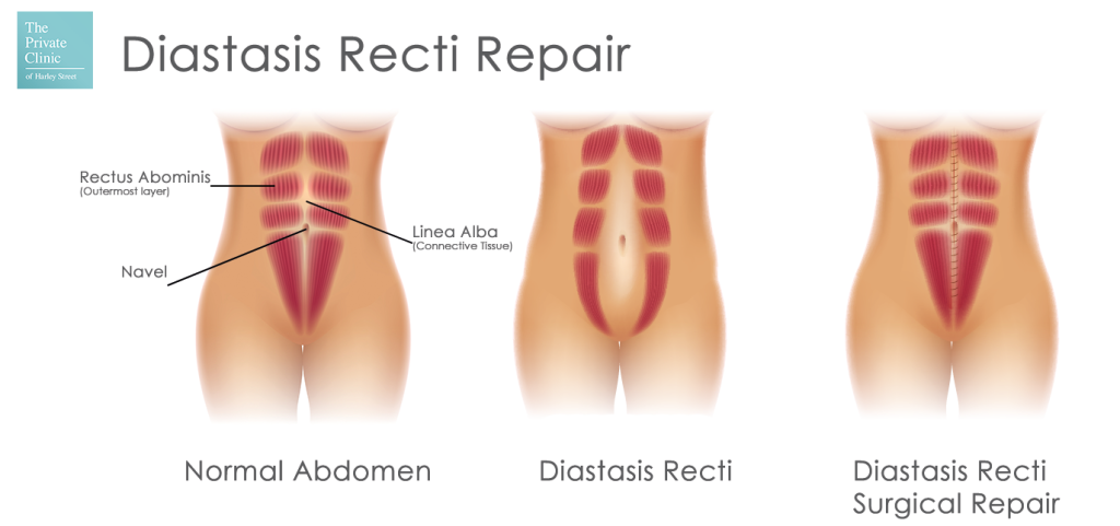 Diastasis recti surgical repair tummy tuck