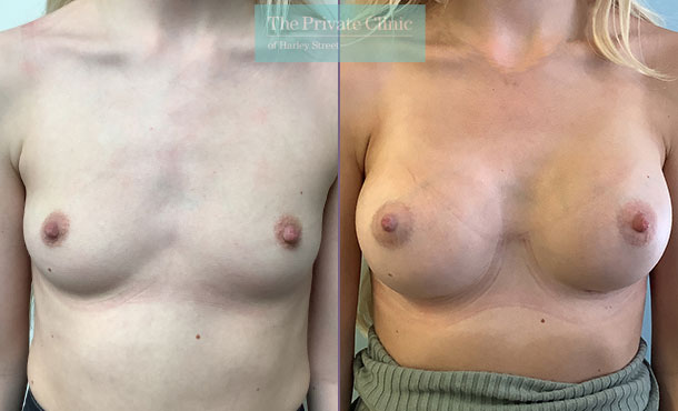 birmingham-breast-enlargement-before-after-breast-implants