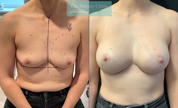 breast-enlargement-near-me-birmingham-before-after-results