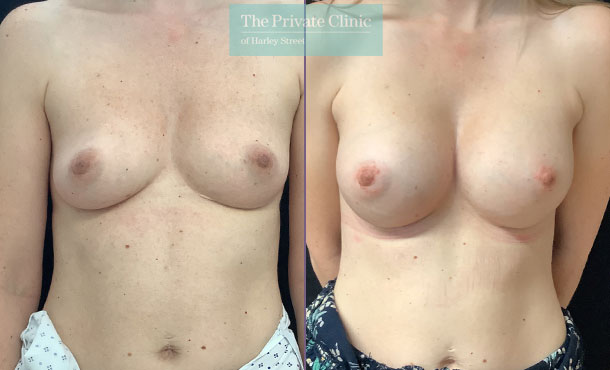 breast-implants-birmingham-boob-job-enlargement-augmentation-surgery-before-after-photo