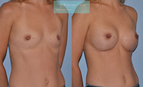 breast enlargement before after photos UK images