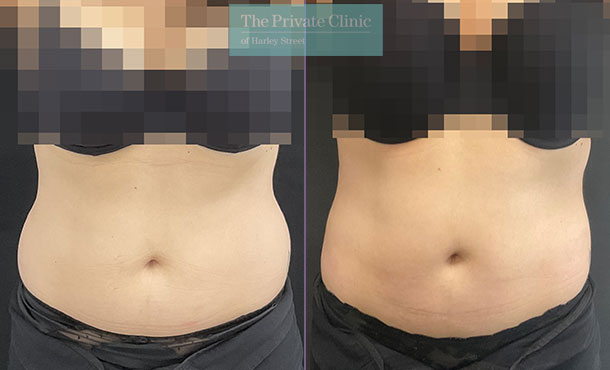 stomach liposuction for fat loss before after photo results