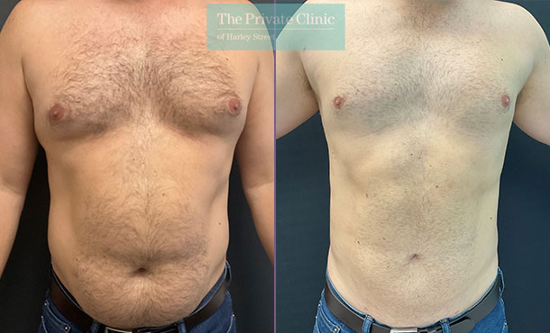 male abdomen liposuction fat removal before after photo