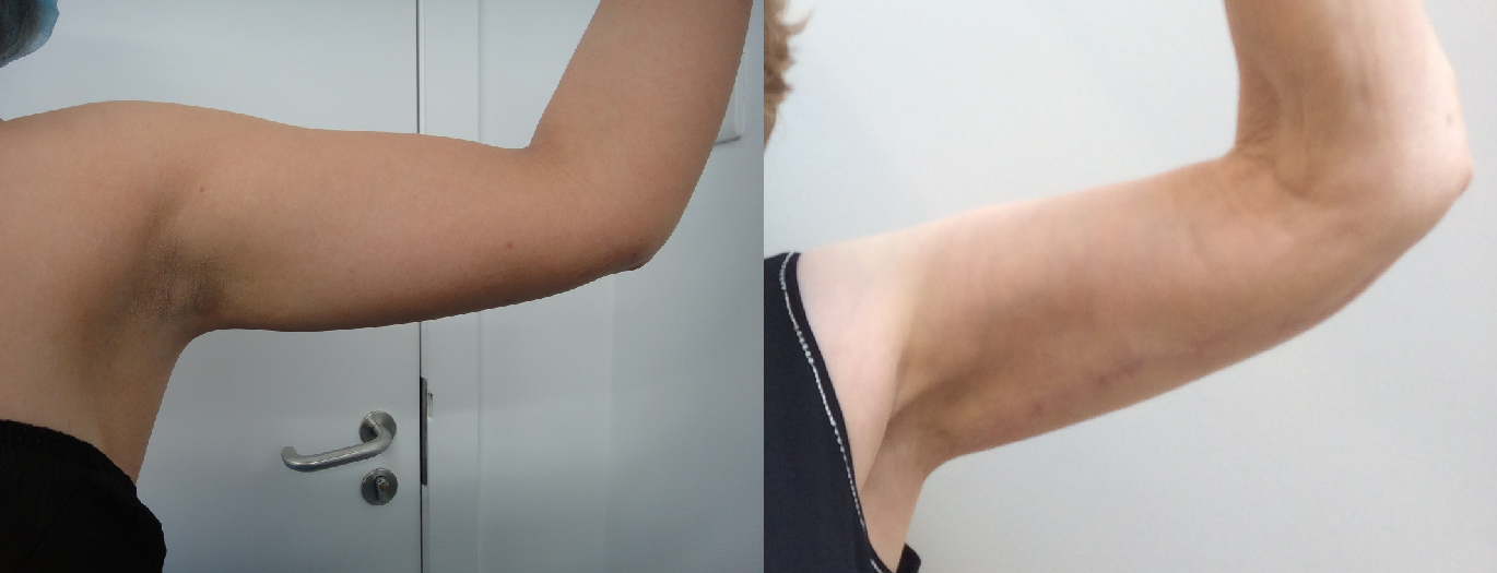 Arm fat reduction Liposuction, Arm Lift Surgery, lose upper arm fat