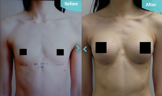 Breast Augmentation and Reduction, Boob Job natural look