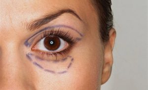 Blepharoplasty Plastic Surgery upper and lower eyelids