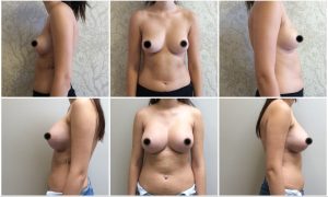 Breast Implants before after photos uk