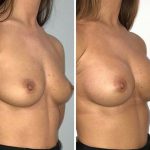 Breast augmentation procedure before after photos