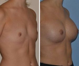 Breast implants size and proportions before after photo