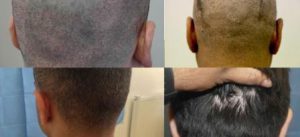 no scarring FUE hair transplant procedure