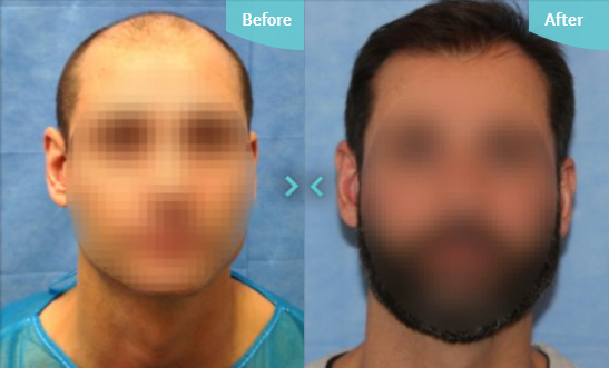 Male pattern baldness treatment options | Norwood Scale of Hair loss ...