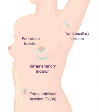 BREAST AUGMENTATION – FOUR TYPES OF INCISIONS