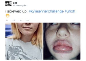 Social media has been flooded with unhappy attempts to get a bigger pout. 