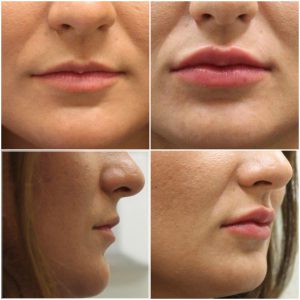 Before and after Lip Fillers at The Private Clinic, Bristol