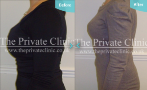 MicroLipo_Breast_Reduction_before_and_after