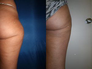 liposuction outer thigh before and after photos