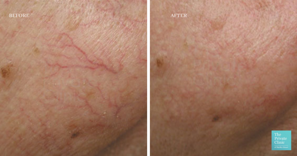 Thread spider veins treatment before after photo