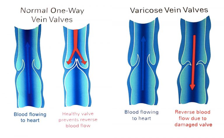 Varicose Veins Removal Treatments: The Private Clinic vs. the NHS