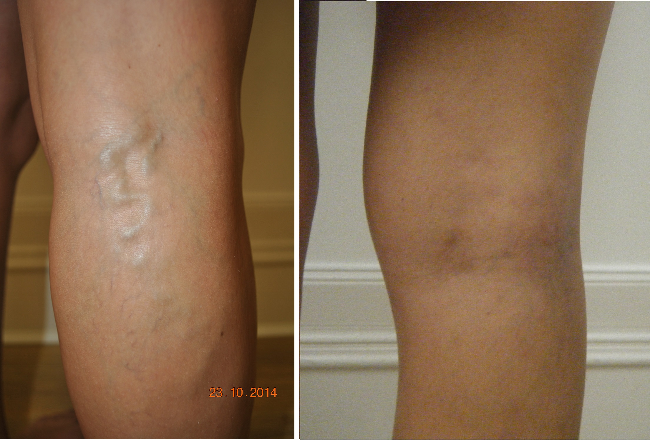 Sclerotherapy or Laser Treatment for Varicose Veins - Which is better