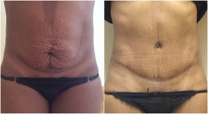 abdominoplasty before after