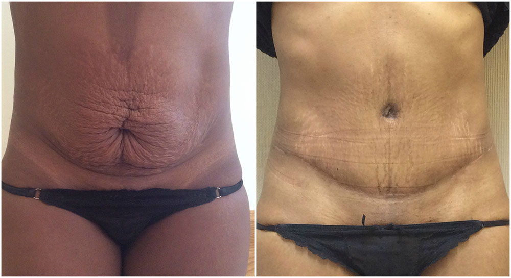 Fully Abdominoplasty vs. Mini Tummy Tuck  Centre for Aesthetic &  Reconstructive Surgery