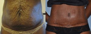 abdo surgery tummy tuck patient story