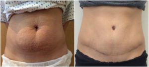 tummy tuck before after images