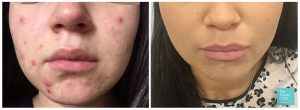 best acne treatment UK before after photos