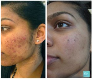 acne treatment for sensitive skin before after photo london