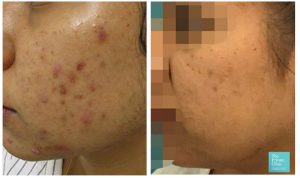 acne treatments near me laser nlite results before after photo