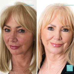 upper blepharoplasty eyelid surgery before and after photo 