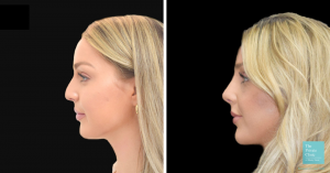 preservation rhinoplasty before and after photo