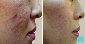 acne scars before and after dermaroller treatment