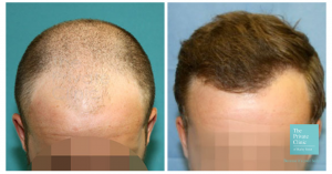 hair transplant midscalp crown area before and after photo