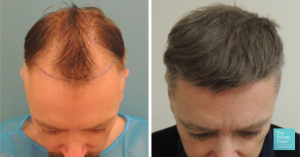 True or False Hair Loss Can Be Reversed 