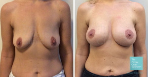 Before and after image of a breast implant and nipple lift