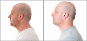 rhinoplasty men before and after photo