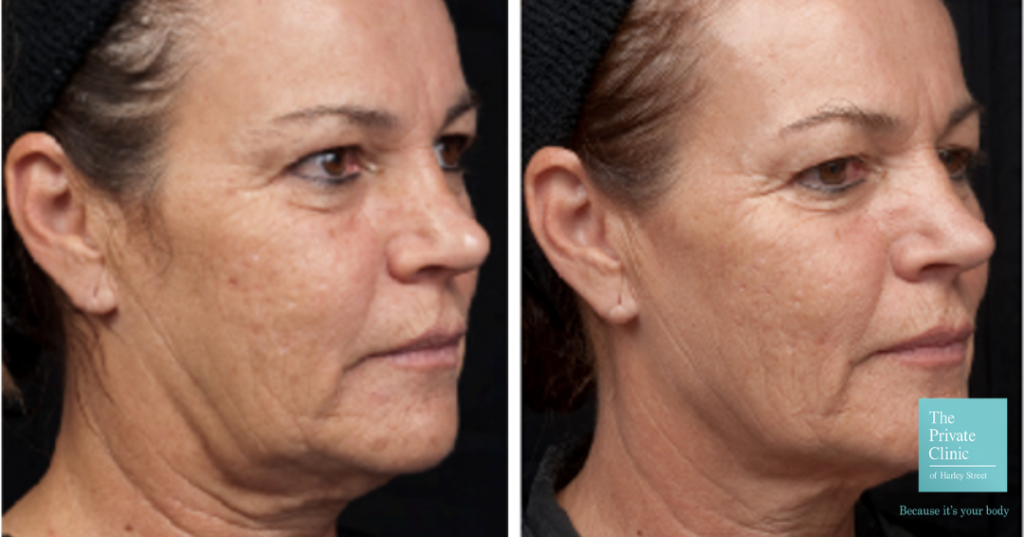 Thermage treatment Before and after photo