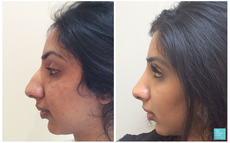 Rhinoplasty Nose Job Top Doctors UK Best Nose Surgeons For Rhinoplasty 