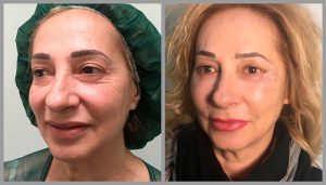 blepharoplasty eye lid eyebag surgery before and after photos