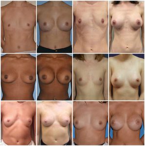 breast augmentation Before and After Photos private clinic