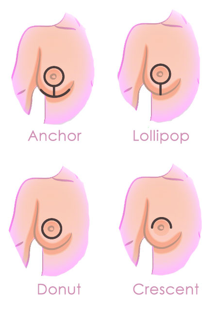 Breast Lift  Mastopexy & Breast Uplift London, UK Prices & Cost