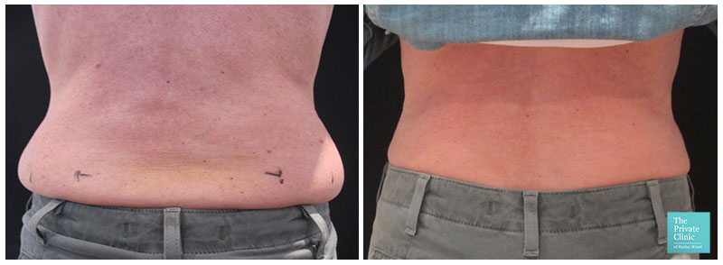 Non-Invasive Fat Removal: An Honest Review on CoolSculpting