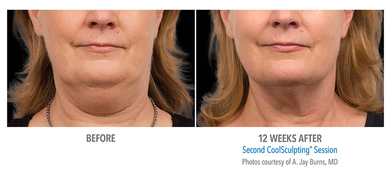 Fat Freezer Chin and Neck Sculpting System @