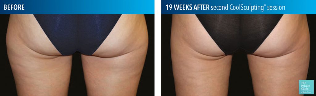 coolSculpting for the thighs before and after photo