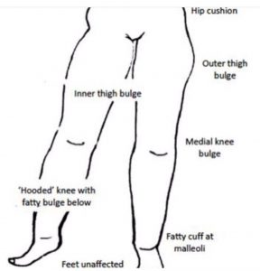 diagram-lipoedema-the-private-clinic