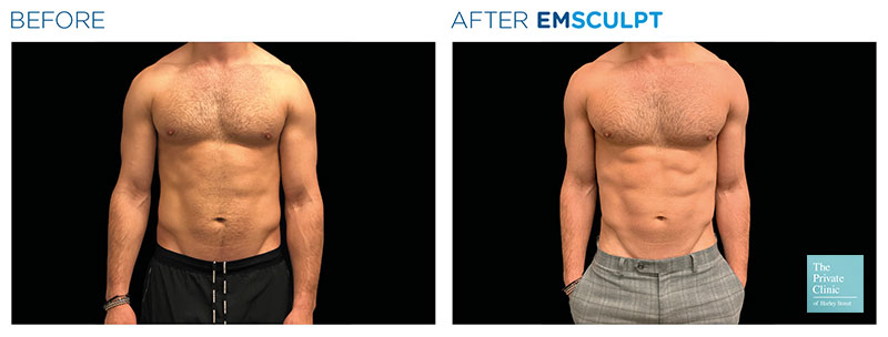 https://www.theprivateclinic.co.uk/wp-content/uploads/emsculpt-muscle-building-abs-6-pack-male-abdomen-before-after-001.jpg