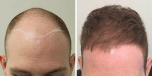 Hair Transplant Before and After Photos